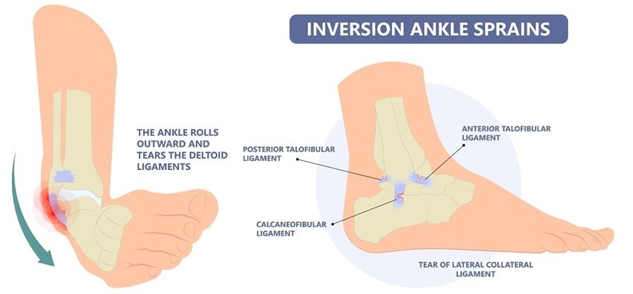 ANTERIOR TALOFIBULAR LIGAMENT