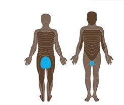 Cauda equina syndrome