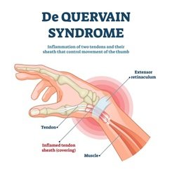 DE QUERVAIN’S DISEASE