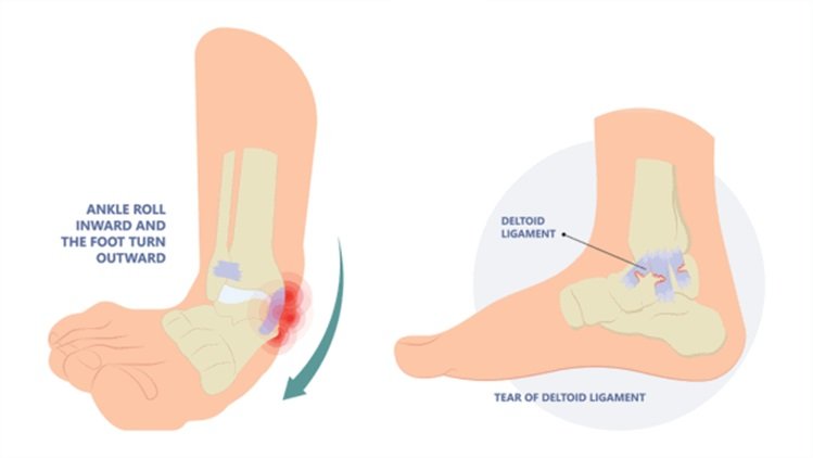 DELTOID LIGAMENT INJURY