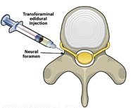 Epidural Steroid