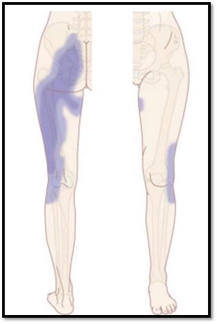 Sacroiliac joint pain