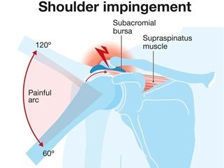 Shoulder impingment