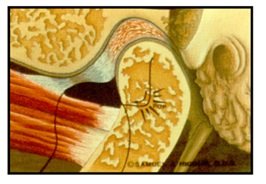 TMJ Disk Disorder- with reduction (I, II)