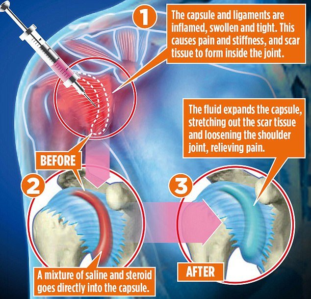 AC Joint Separation