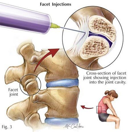 Facet-Joint-Syndrome-Treatment-Doctor-Spine-Specialist-NYC